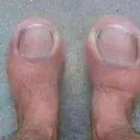 BS ostříhanej palec